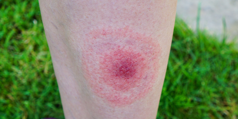 Lyme Disease in Winston-Salem, North Carolina