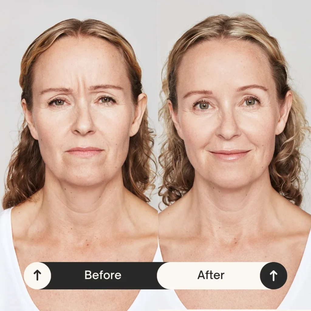 Dysport before and after