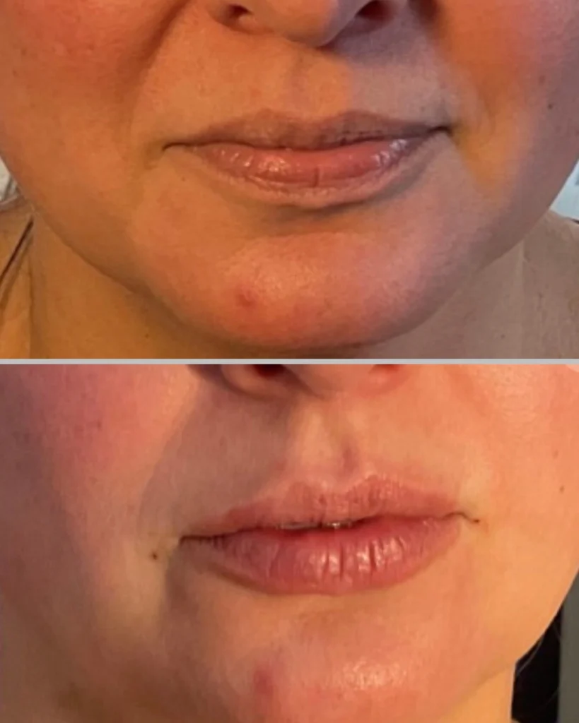 lip filler Winston-Salem, NC